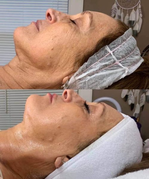 Cryoskin Facial